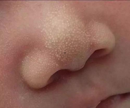 水痘可以吃小白瓜吗,小白瓜的适宜食用指南